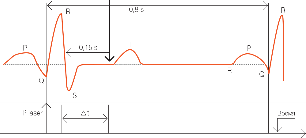 Типичная электрокардиограмма сердца человека с указанием предпочтительного временного интервала Δt воздействия лазерного импульса между R- и Т-пиками, Δt <0,15 сек. В этот период сердце электрически нейтрально. Plaser  временная точка посылки сигнала синхронизации, Δt регулируемое время задержки лазерного импульса 
