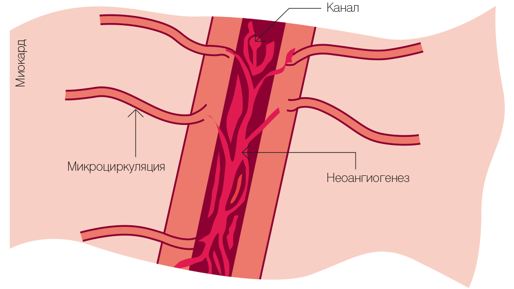 Схема прорастания новых сосудов в миокарде после его перфорации лазерным импульсом 
