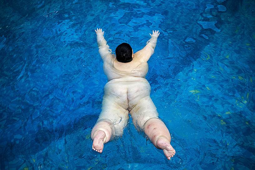 Гуанчжоу, Китай. Четырнадцатилетний подросток с синдромом Прадера—Вилли (редкое генетическое заболевание) плавает в бассейне, выполняя упражнения для похудения, в больнице