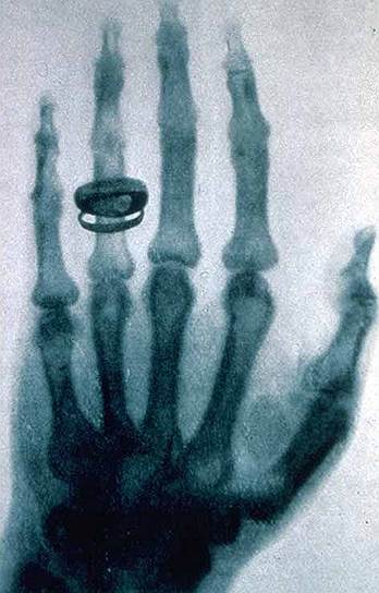 1895 год. Немецкий физик Вильгельм Рентген в Вюрцбурге (Германия) впервые объявил об открытии рентгеновских лучей