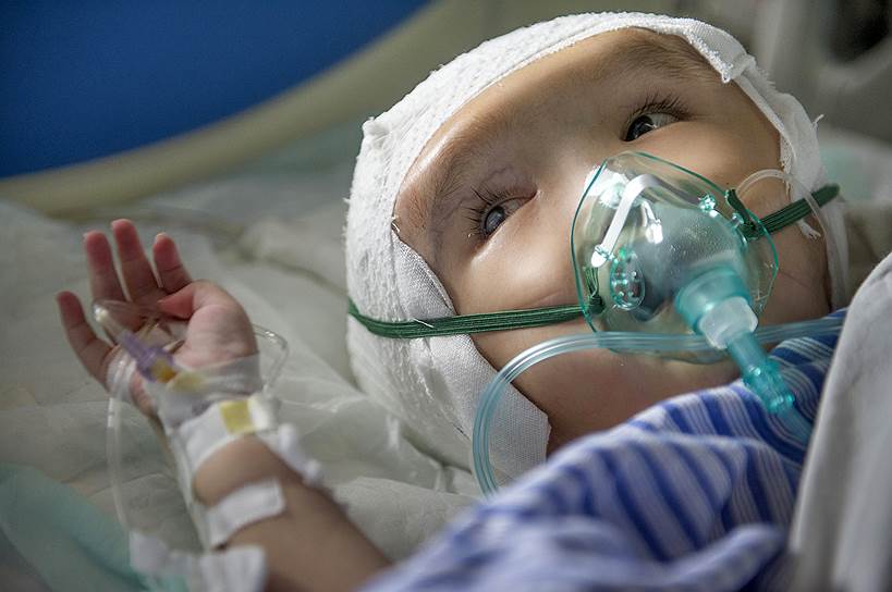 Чанша, Китай. Трехлетняя девочка в больнице после имплантации трех титановых пластин в череп