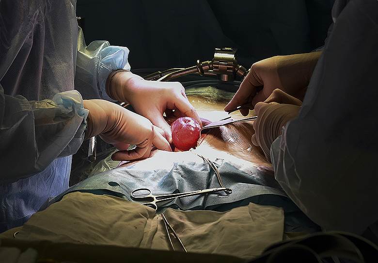 Врачи во время проведения операции по пересадки почки в Институте Склифосовского