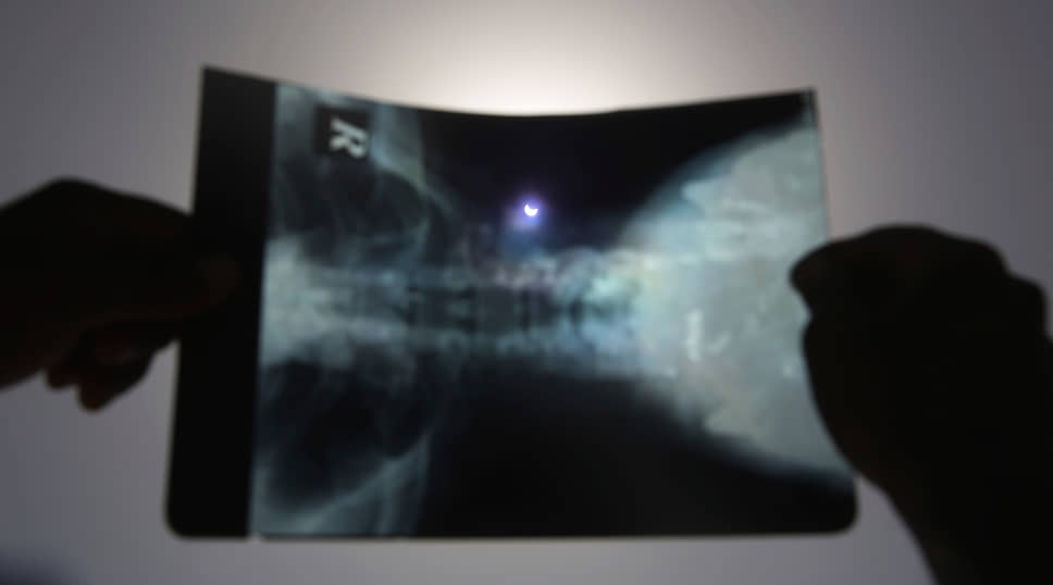Вид на затмение через рентгеновский снимок