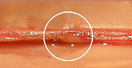 Лазерная сварка кровеносного сосуда – после сварки 