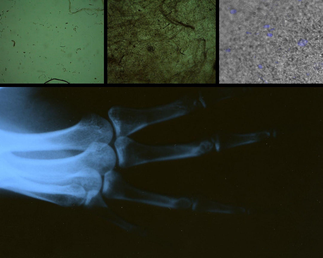 Верхний ряд, слева направо: поверхность композита до и после пяти суток культивации клеток, снимок с оптического микроскопа; культура фибробластов на поверхности композита после трех суток культивации. Нижний ряд — рентгеновский снимок кисти рук
