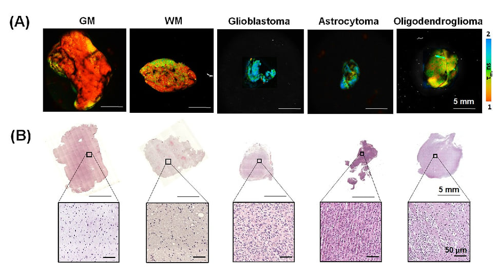 A) FLIM-изображения свежих образцов ткани нормального серого вещества (GM), белого вещества (WM) и опухолей — глиобластомы, астроцитомы и олигодендроглиомы. (B) Окрашенные гистологические срезы, соответствующие FLIM-изображениям