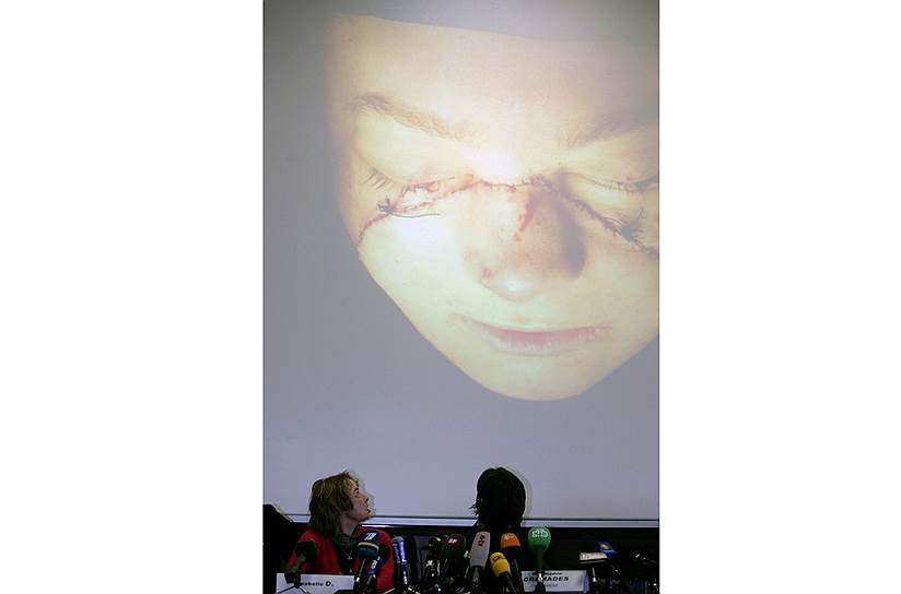 Изабель Динуар (слева) на первой послеоперационной пресс-конференции смотрит на фотографию своего нового лица, сделанную сразу после пересадки 
