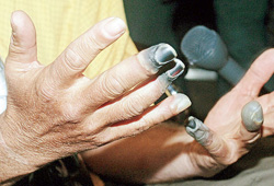 Марк Инглис взошел, но отморозил пальцы. Им грозит ампутация