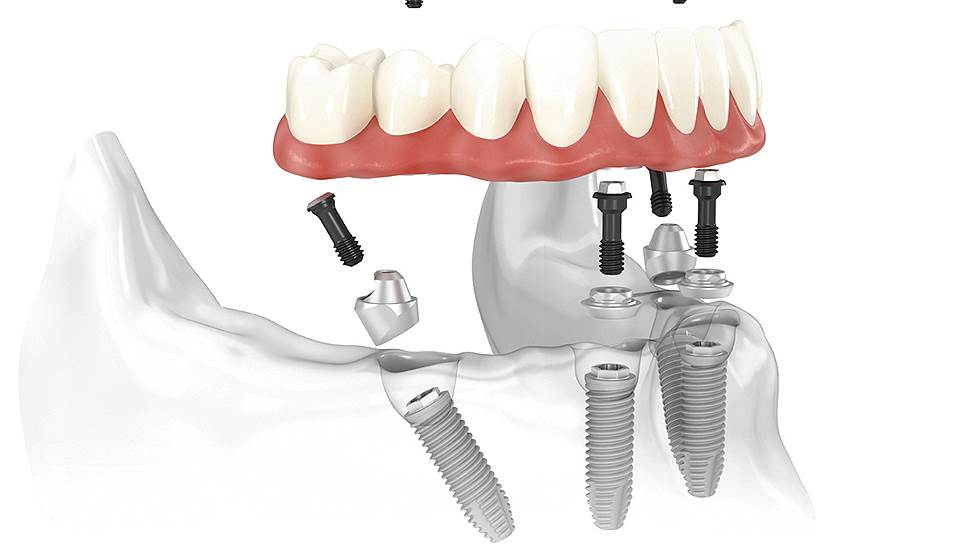 У стоматологов концепция &quot;All-on-4&quot; приобрела доверие именно благодаря возможности установить несъемный протез, который позволяет полностью восстановить функции жевания и исключить проблемы с речью 
